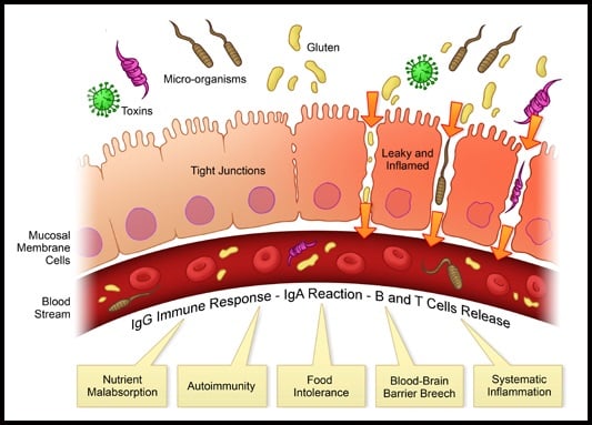 glutine e leaky gut