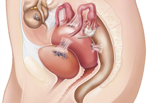 endometriosi e microbiota