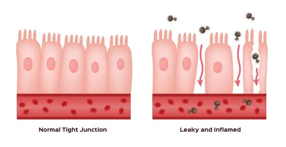 glutammina leaky gut